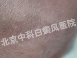 白癜风医院
